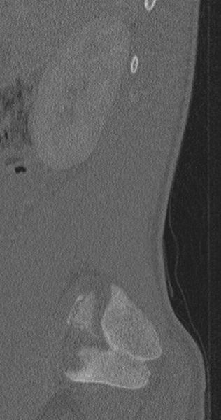 File:Chance fracture (Radiopaedia 40360-42912 Sagittal bone window 85).png