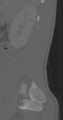 Chance fracture (Radiopaedia 40360-42912 Sagittal bone window 85).png