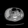 Chance fracture with duodenal and pancreatic lacerations (Radiopaedia 43477-46864 A 17).jpg