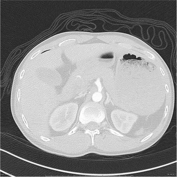 File:Chest and abdomen multi-trauma (Radiopaedia 26294-26425 lung window 108).jpg