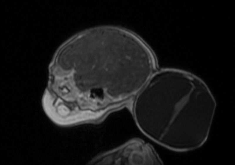 File:Chiari III malformation with occipital encephalocele (Radiopaedia 79446-92559 Sagittal T1 C+ mpr 19).jpg