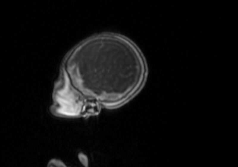 File:Chiari III malformation with occipital encephalocele (Radiopaedia 79446-92559 Sagittal T1 C+ mpr 58).jpg