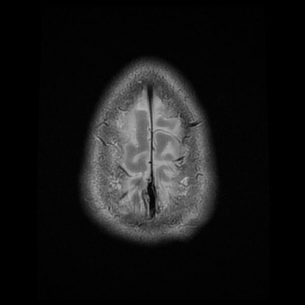 File:Chiasmatic-hypothalamic juvenile pilocytic astrocytoma (Radiopaedia 78533-91235 Axial T2 26).jpg