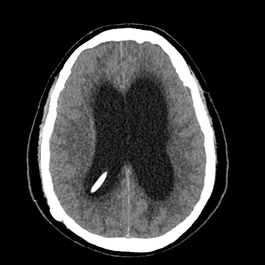 Chiasmatic-hypothalamic juvenile pilocytic astrocytoma (Radiopaedia 78533-91237 Axial non-contrast 37).jpg