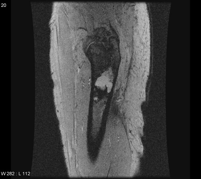 File:Chondrosarcoma - proximal femur (Radiopaedia 6171-7623 Sagittal T2 fat sat 1).jpg
