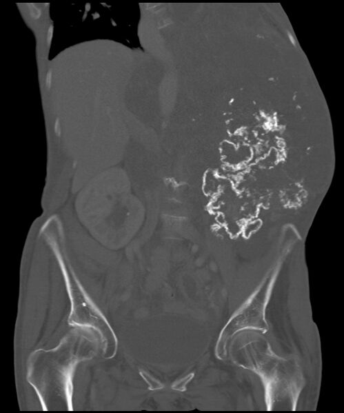 File:Chondrosarcoma of the spine (Radiopaedia 49871-55143 Coronal bone window 18).jpg