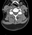 Chordoma (C4 vertebra) (Radiopaedia 47561-52188 Axial non-contrast 29).png