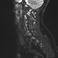Chordoma (C4 vertebra) (Radiopaedia 47561-52189 Sagittal T2 fat sat 1).png