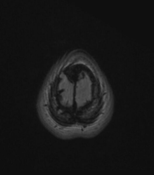 File:Choroid plexus carcinoma (Radiopaedia 91013-108553 Axial FLAIR C+ 198).jpg