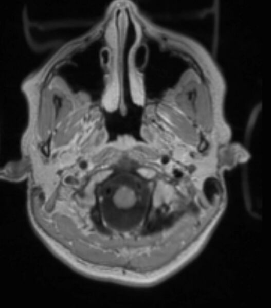 File:Choroid plexus carcinoma (Radiopaedia 91013-108553 Axial T1 C+ 76).jpg