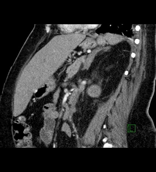 File:Chromophobe renal cell carcinoma (Radiopaedia 84239-99519 D 51).jpg