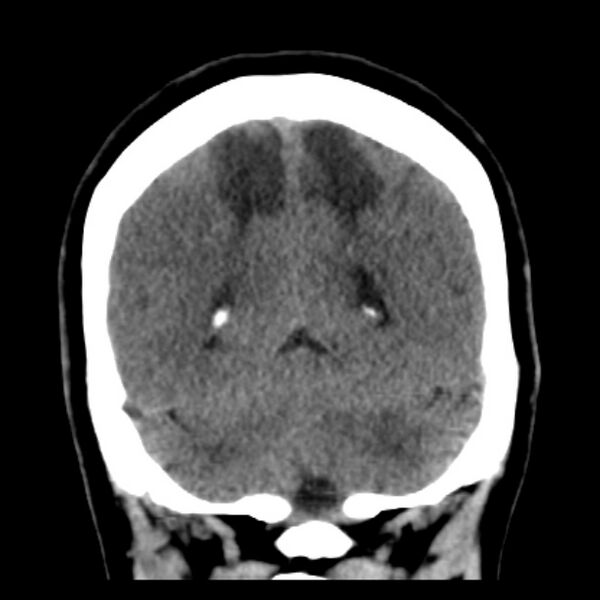 File:Chronic bilateral occipital lobe infarcts (Radiopaedia 31276-31996 Coronal non-contrast 36).jpg