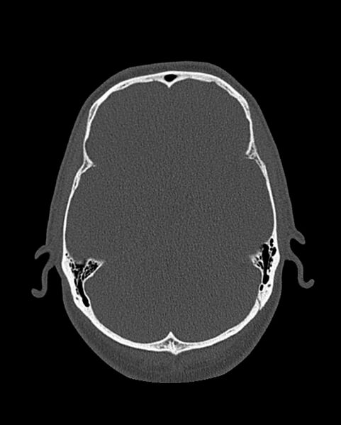 File:Chronic maxillary sinusitis caused by a foreign body (Radiopaedia 58521-65676 Axial bone window 302).jpg