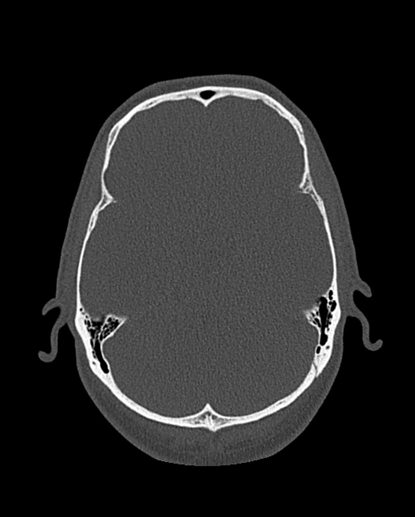 Chronic maxillary sinusitis caused by a foreign body (Radiopaedia 58521-65676 Axial bone window 302).jpg