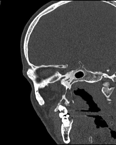 File:Chronic maxillary sinusitis caused by a foreign body (Radiopaedia 58521-65676 Sagittal bone window 58).jpg