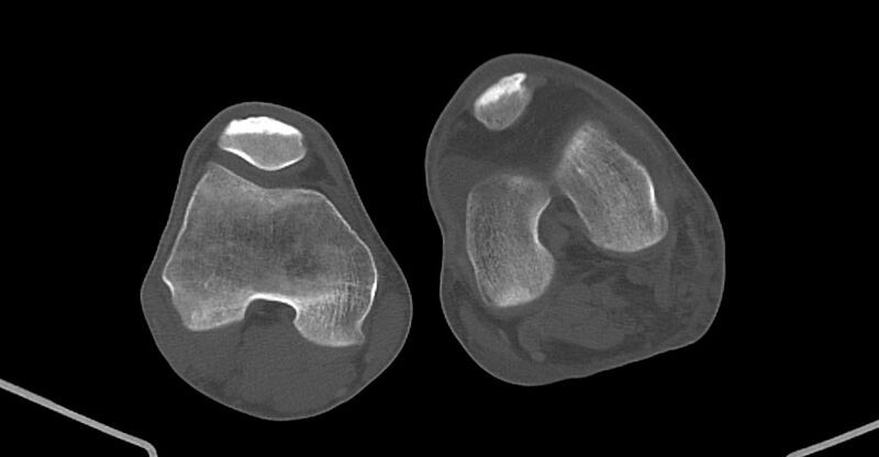 File:Chronic osteomyelitis (with sequestrum) (Radiopaedia 74813-85822 Axial non-contrast 185).jpg