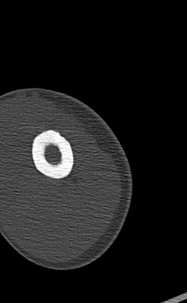File:Chronic osteomyelitis of the distal humerus (Radiopaedia 78351-90971 Axial 103).jpg