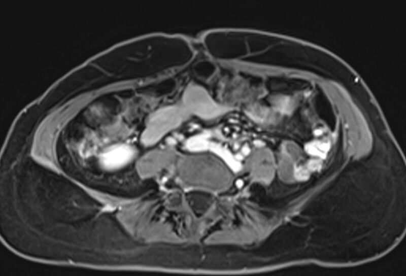File:Chronic pancreatitis - pancreatic duct calculi (Radiopaedia 71818-82250 Axial T1 C+ fat sat 57).jpg