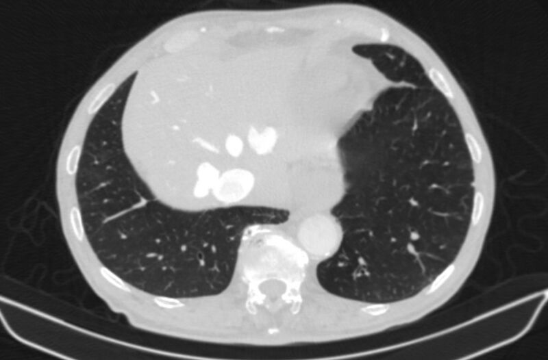File:Chronic pulmonary embolism (Radiopaedia 91241-108843 Axial lung window 78).jpg
