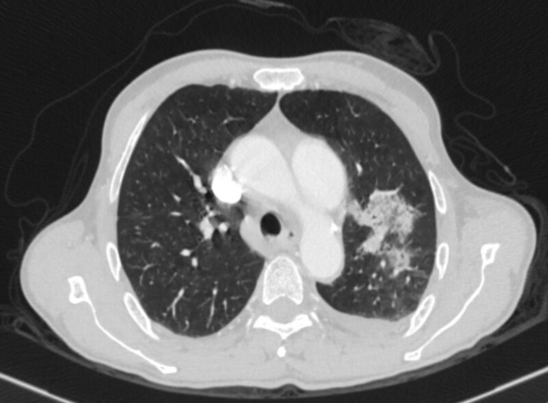 File:Chronic pulmonary embolism with bubbly consolidation (Radiopaedia 91248-108850 Axial lung window 49).jpg