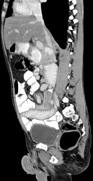 File:Chronic small bowel volvulus (Radiopaedia 75224-86322 C 86).jpg