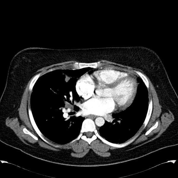 File:Chronic thromboembolic pulmonary hypertension (CTEPH) (Radiopaedia 74597-85531 Axial C+ CTPA 29).jpg