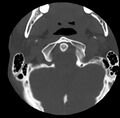 Clay-shoveler fracture (Radiopaedia 22568-22590 Axial bone window 6).jpg