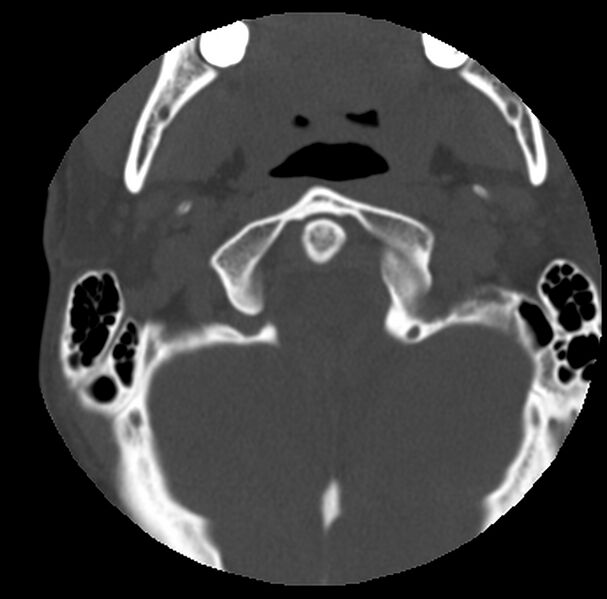 File:Clay-shoveler fracture (Radiopaedia 22568-22590 Axial bone window 6).jpg