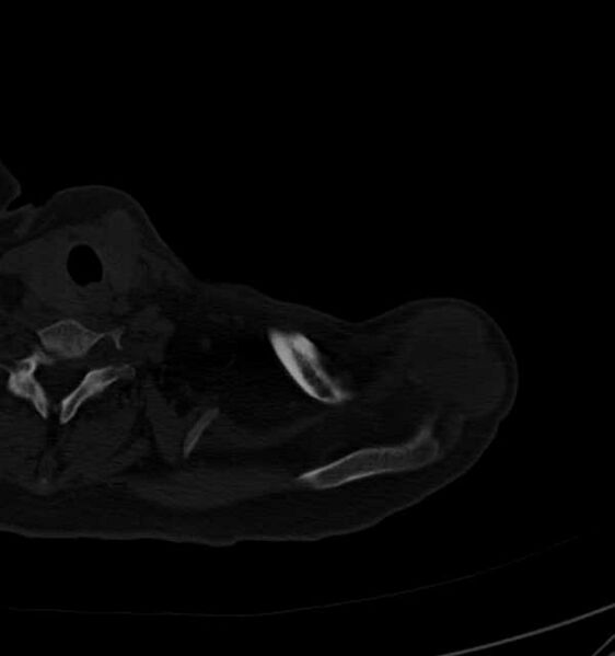 File:Clear cell chondrosarcoma - humerus (Radiopaedia 63104-71612 Axial bone window 12).jpg