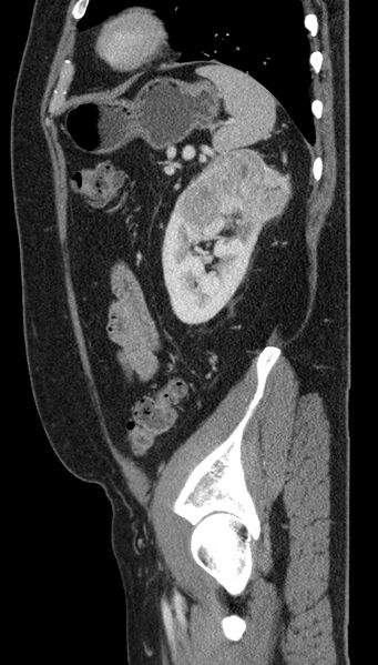 File:Clear cell renal cell carcinoma (Radiopaedia 61449-69393 G 18).jpg