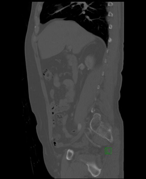 File:Clear cell renal cell carcinoma (Radiopaedia 85006-100539 Sagittal bone window 39).jpg