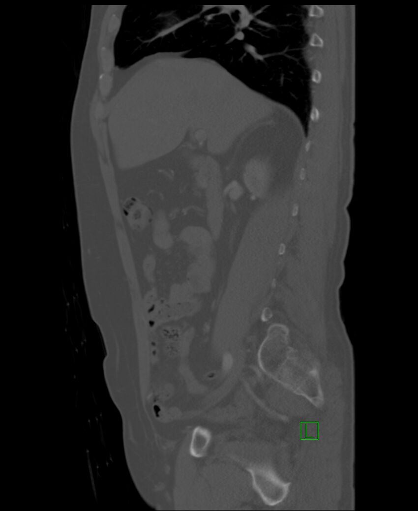 Clear cell renal cell carcinoma (Radiopaedia 85006-100539 Sagittal bone window 39).jpg