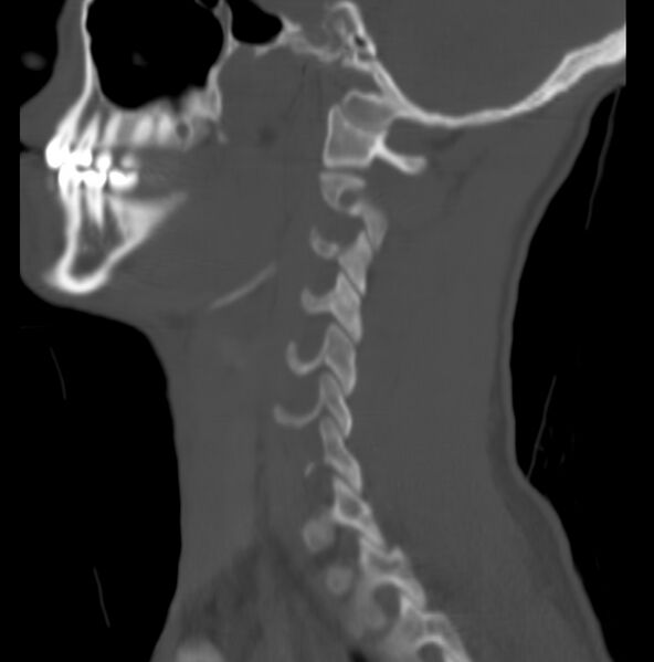 File:Cleft of the posterior arch of C1 mimicking fracture (Radiopaedia 40201-42721 Sagittal bone window 2).jpg