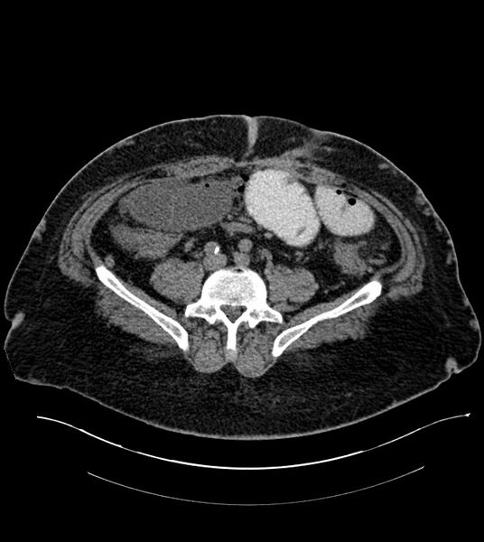 File:Closed-loop small bowel obstruction-internal hernia (Radiopaedia 78439-91096 Axial non-contrast 105).jpg