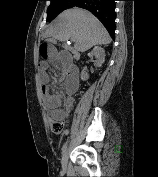 File:Closed-loop small bowel obstruction-internal hernia (Radiopaedia 78439-91096 C 97).jpg