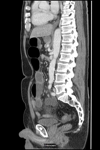 File:Closed loop bowel obstruction and ischemia (Radiopaedia 86959-103180 C 29).jpg