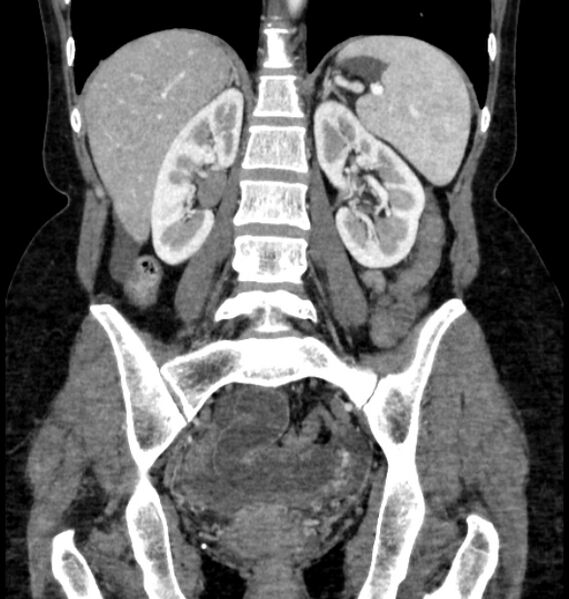 File:Closed loop small bowel obstruction (Radiopaedia 71211-81508 B 83).jpg