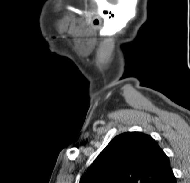 File:Colloid cyst of thyroid (Radiopaedia 22897-22923 Sagittal C+ delayed 9).jpg