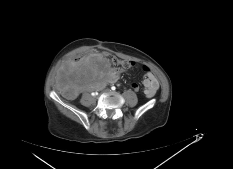 File:Colon cancer mimicking renal cell carcinoma (Radiopaedia 28986-29335 B 50).jpg