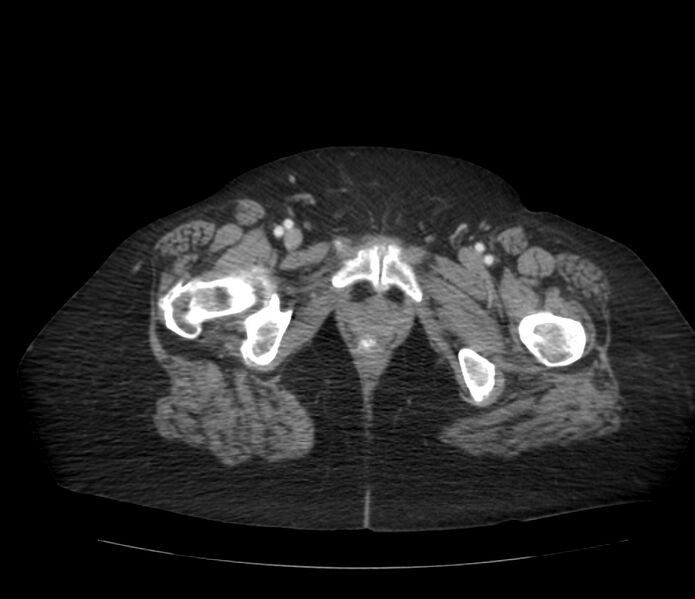 File:Colonic diverticulosis (Radiopaedia 22934-22957 A 77).jpg