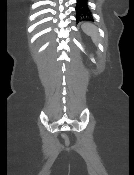 File:Colonic pseudo-obstruction (Radiopaedia 79752-92980 B 50).png
