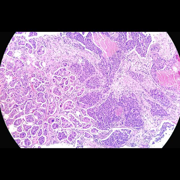 File:Invasive ductal carcinoma (histology) (Radiopaedia 77992).jpeg