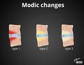 Modic-type endplate changes- diagram (Radiopaedia 36953).jpg