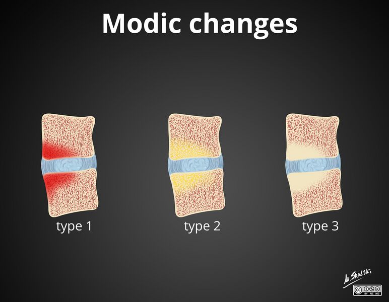 File:Modic-type endplate changes- diagram (Radiopaedia 36953).jpg