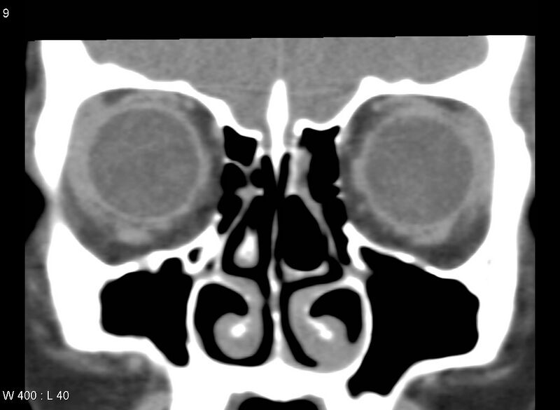 File:Nasolacrimal dacrocystocele (Radiopaedia 13814-13694 Coronal liver window 10).jpg