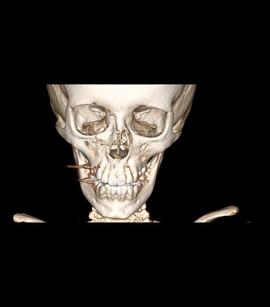 File:Nasoorbitoethmoid fracture (Radiopaedia 90044-107205 3D VRT 18).jpg
