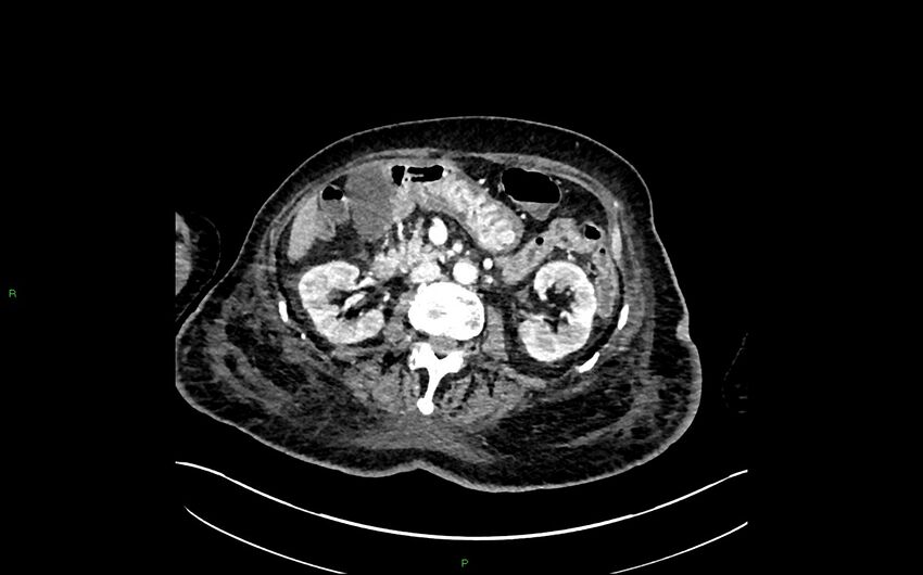 Neo-terminal ileal stricture (Crohn disease) (Radiopaedia 33790-34948 A 179).jpg