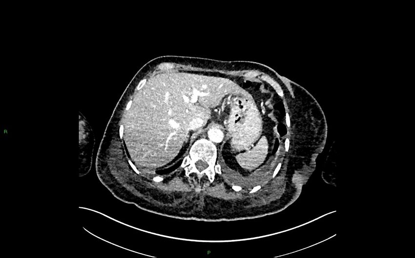 Neo-terminal ileal stricture (Crohn disease) (Radiopaedia 33790-34948 A 77).jpg