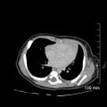 Neonatal neuroblastoma (Radiopaedia 56651-63438 Axial non-contrast 3).jpg