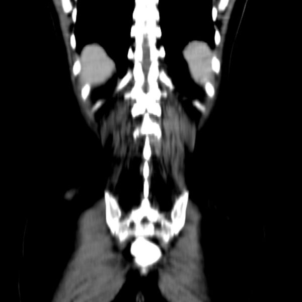 File:Neurofibroma - spine (Radiopaedia 27891-28125 B 27).jpg